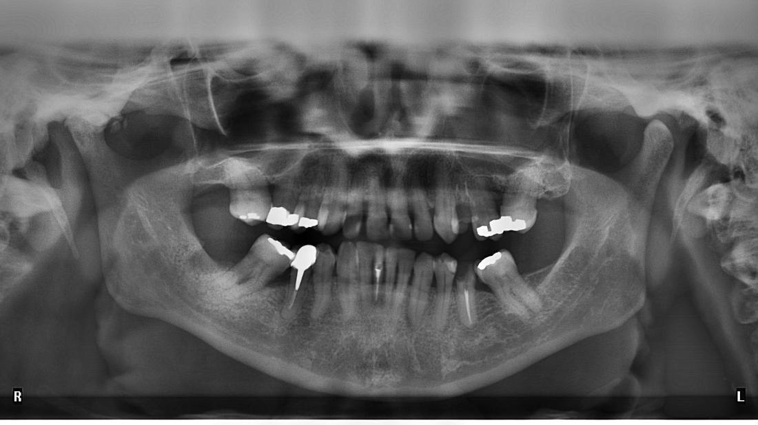 Reamer Family Dentistry Blog Why Do We Take Dental Xrays?